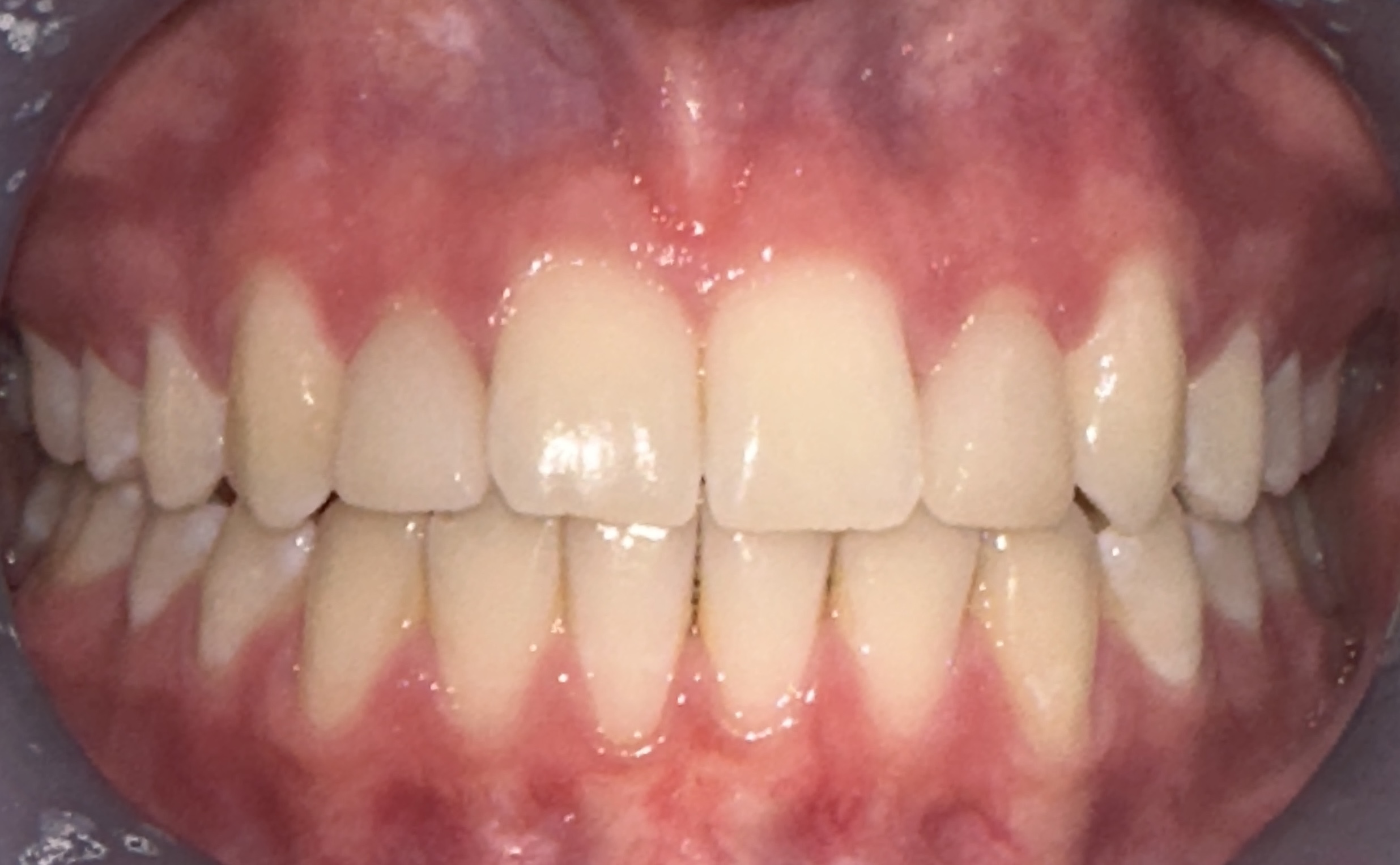 After Invisalign