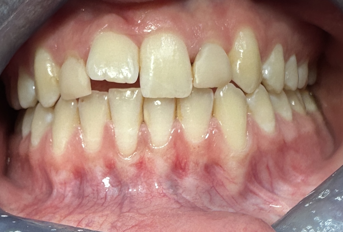 Before Invisalign